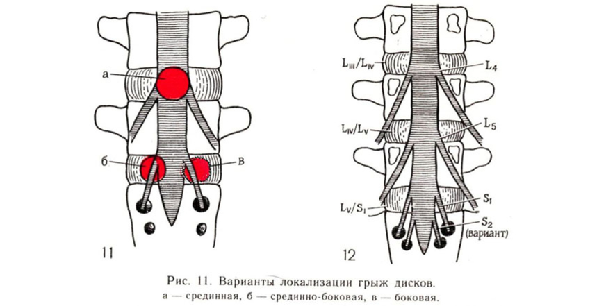 Грыжа диска. Грыжа диска локализация. Задняя срединная грыжа диска. Срединная грыжа межпозвонкового диска. Грыжа МПД.